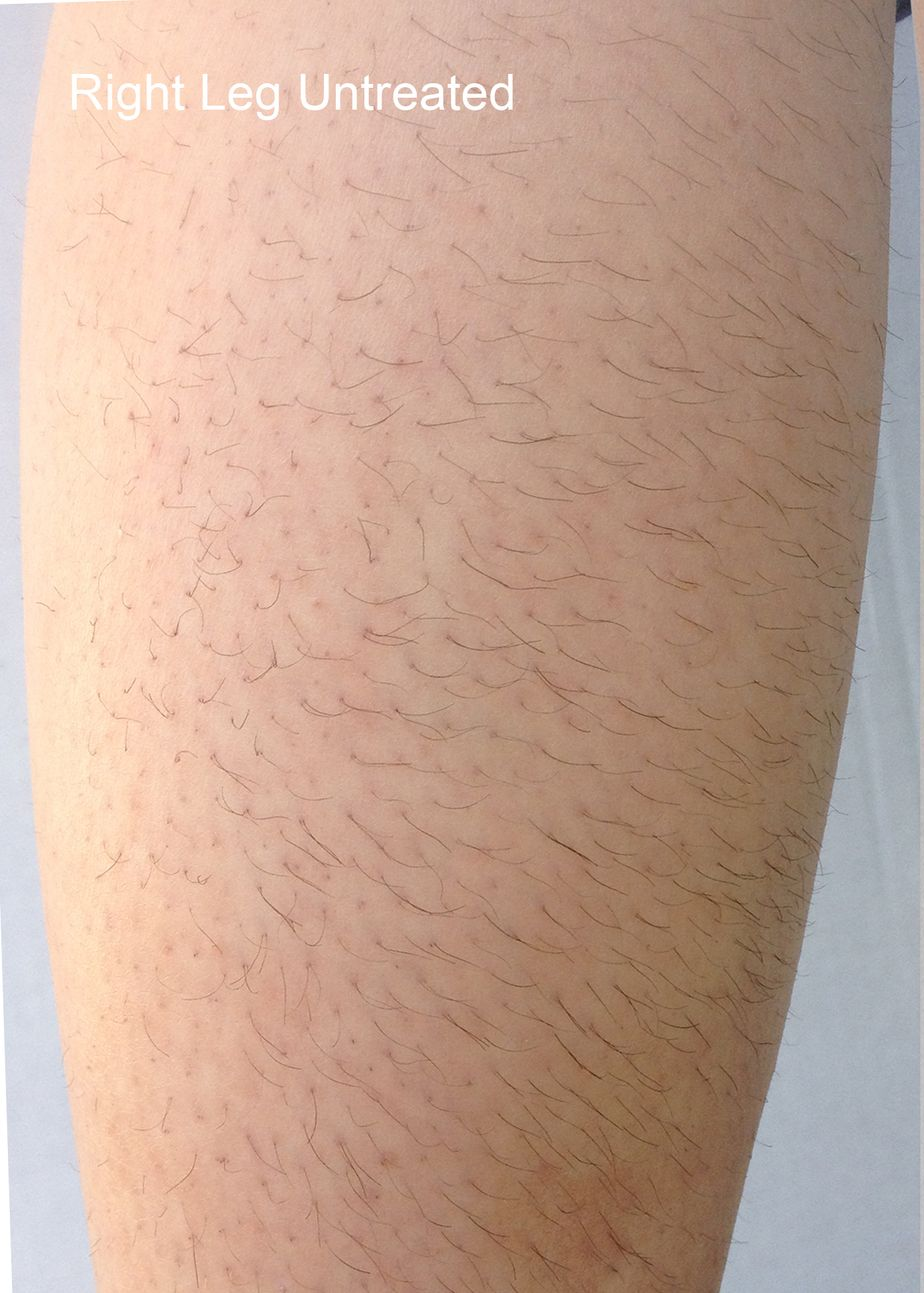 Right leg with untreated hair; light skin and visible hair follicles.
