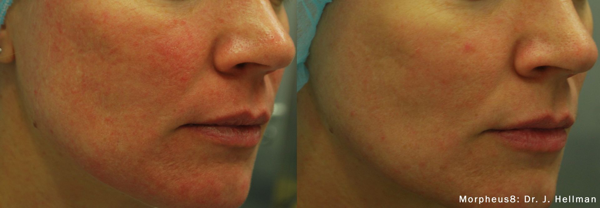 A before and after photo of a woman 's face with red spots.