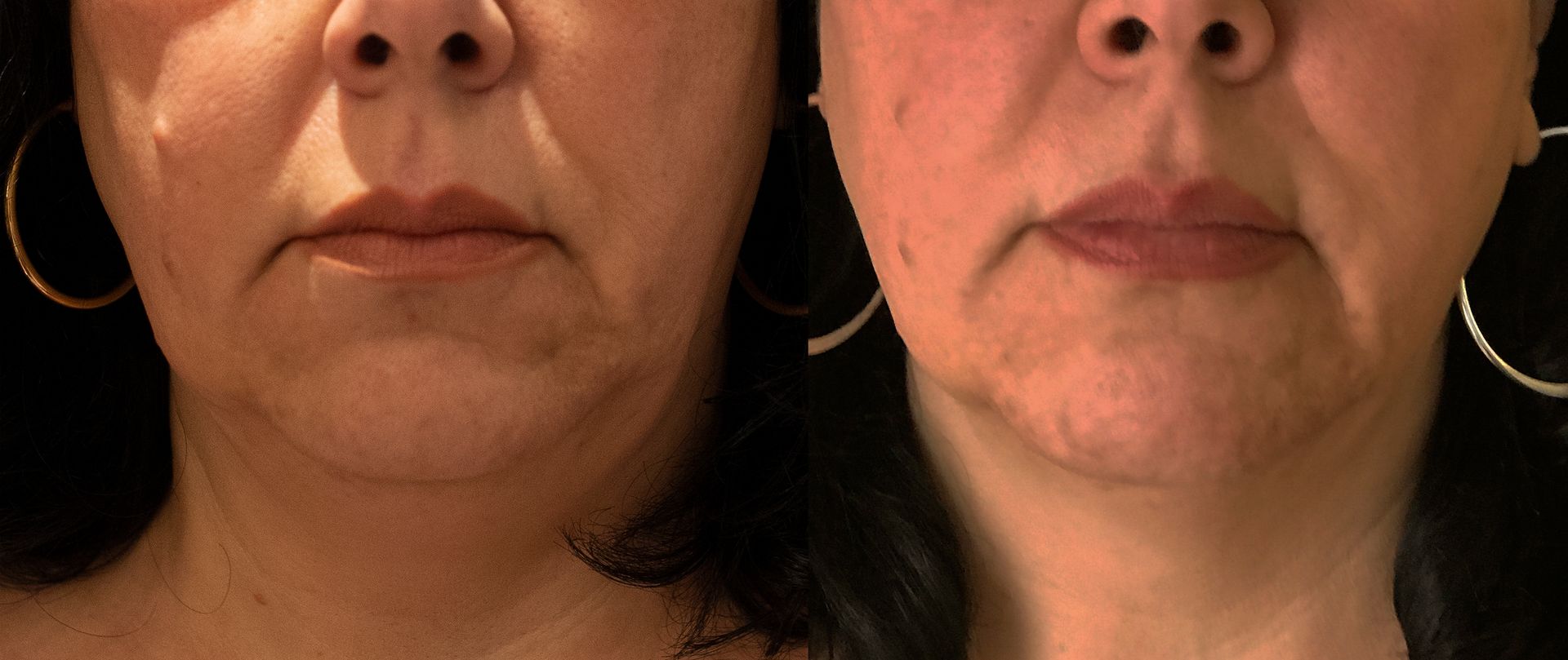 A before and after photo of a woman 's face and neck.