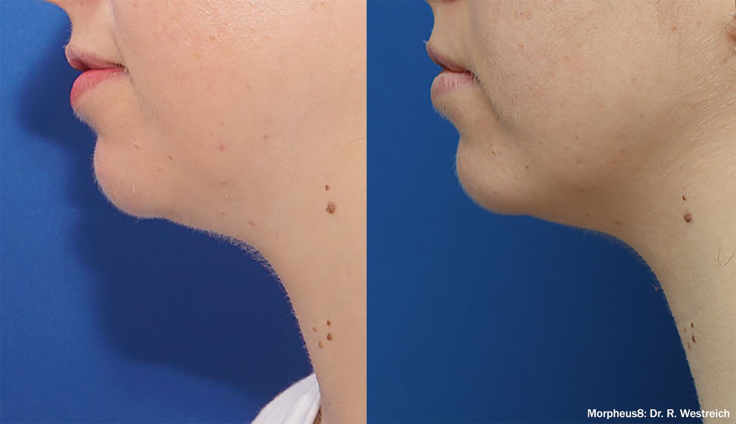A before and after photo of a woman 's neck and chin