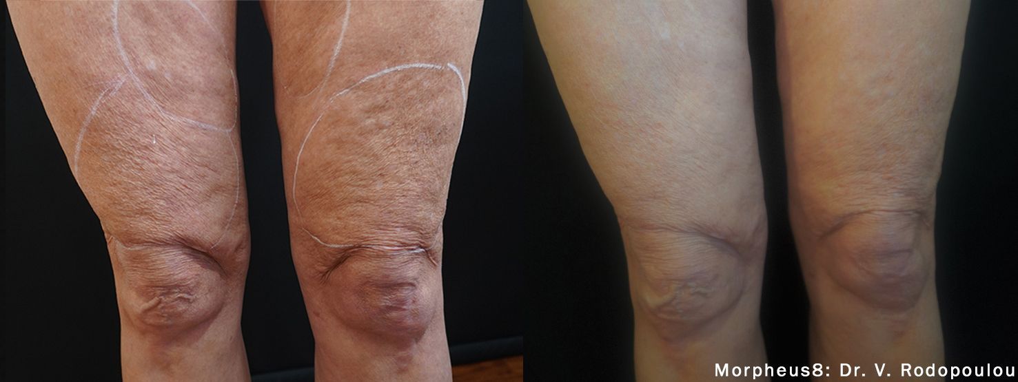 A before and after photo of a person 's legs