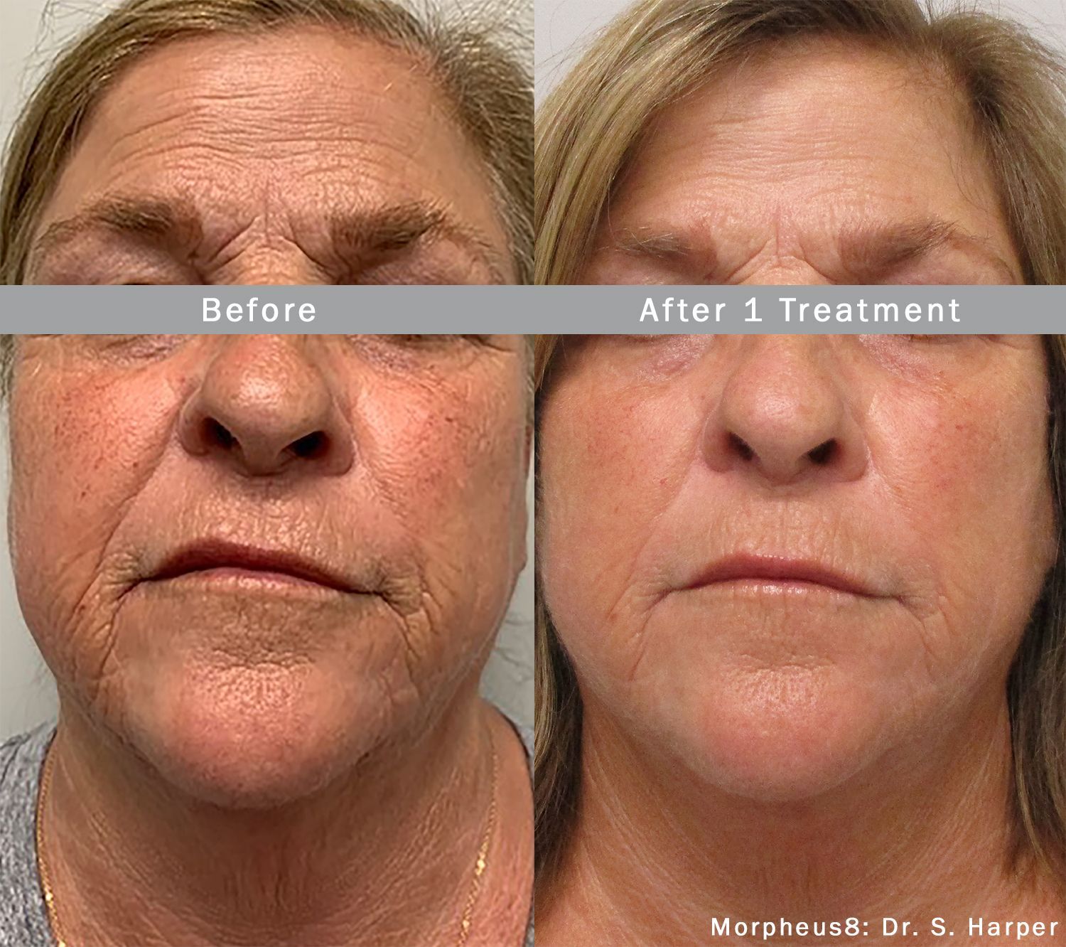A before and after photo of a woman 's face