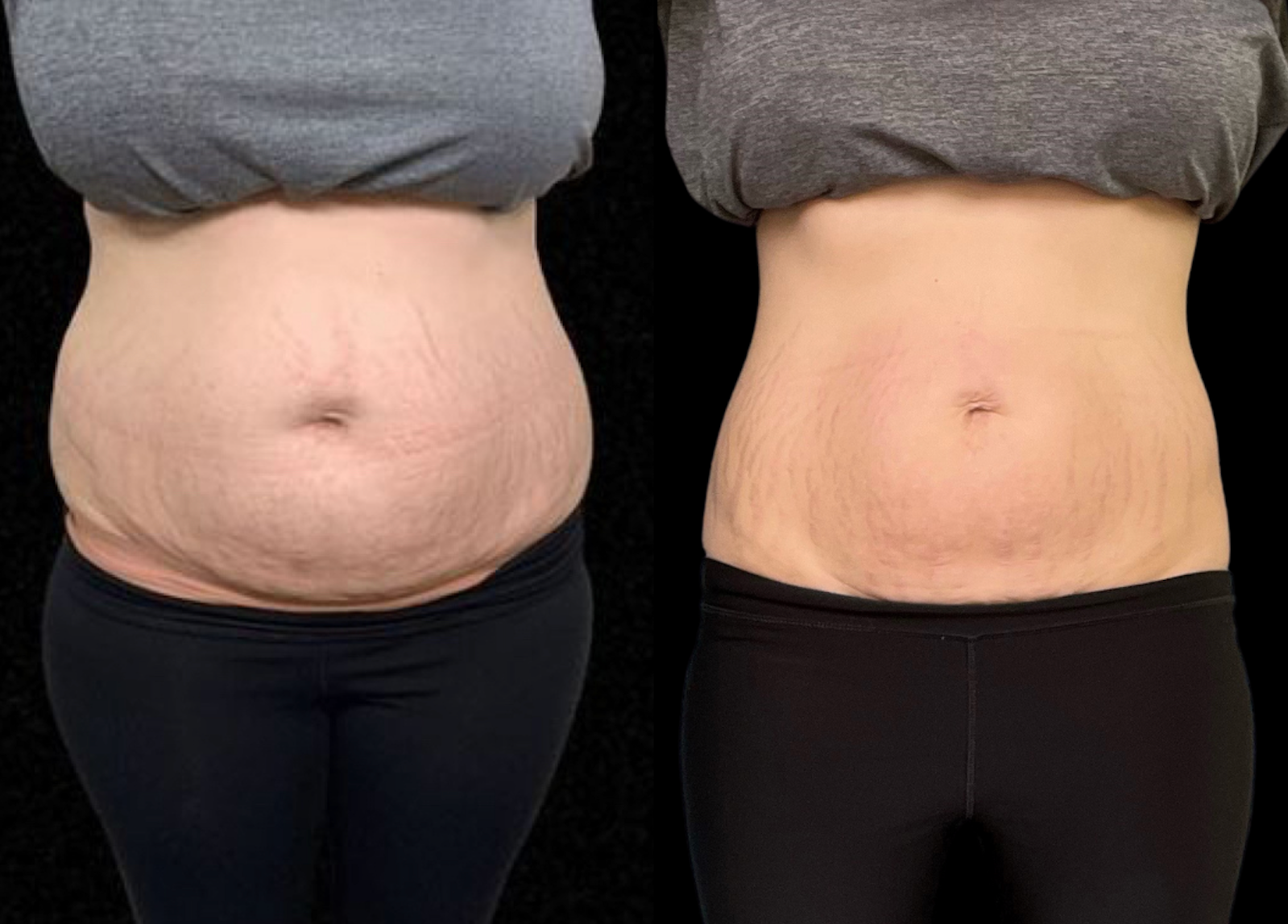 A before and after photo of a woman 's neck and chin