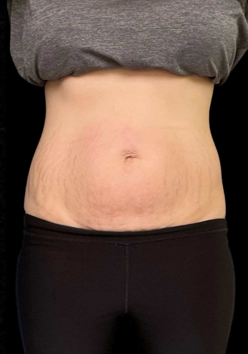Person's torso with stretch marks on abdomen wearing gray shirt and black pants.