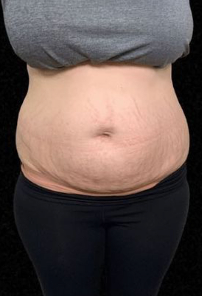 A person's midriff, showing a slightly protruding abdomen and stretch marks, wearing a gray top and black leggings.