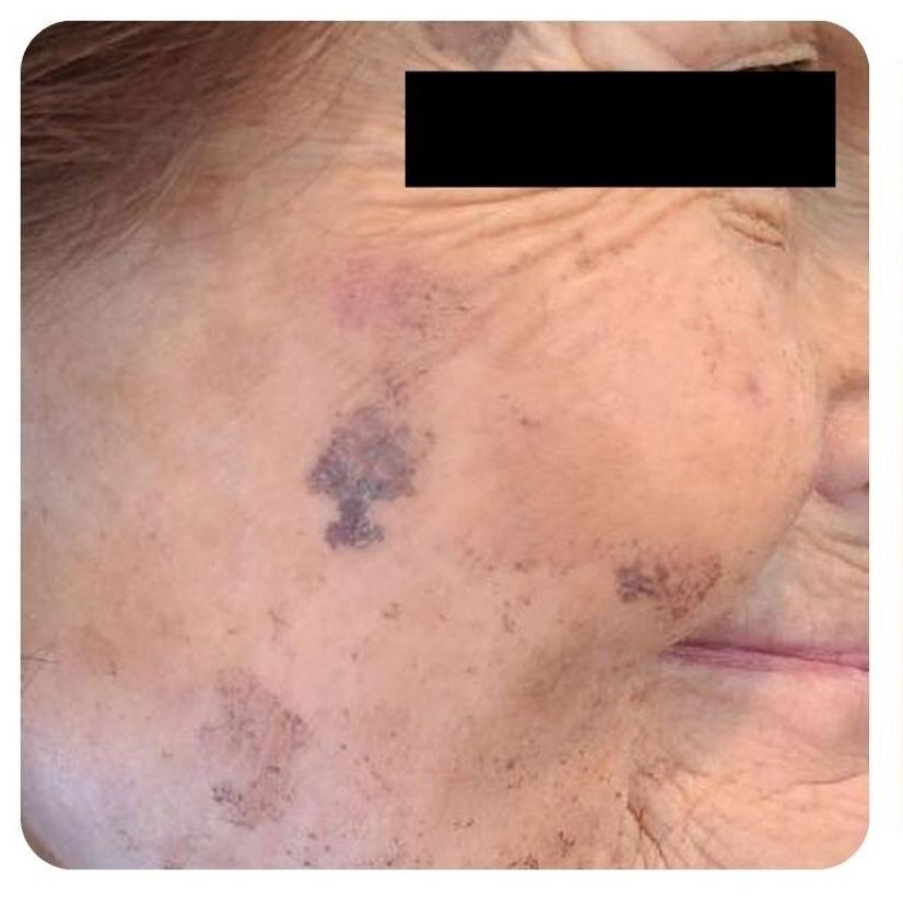 Close-up of a person's cheek with age spots, wrinkles, and a dark, irregular pigmented patch.