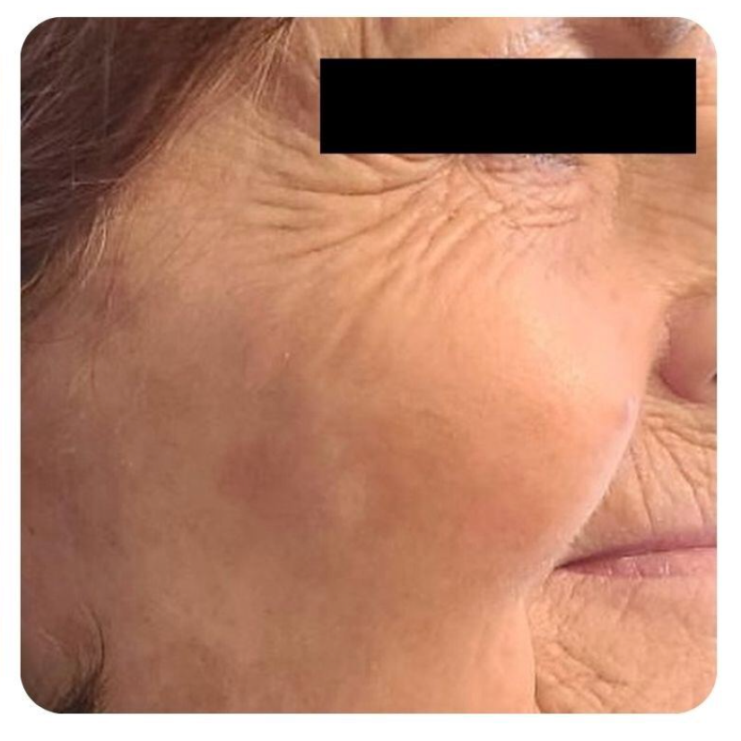 Close-up of a person's face; visible wrinkles and a discoloration on the cheek.