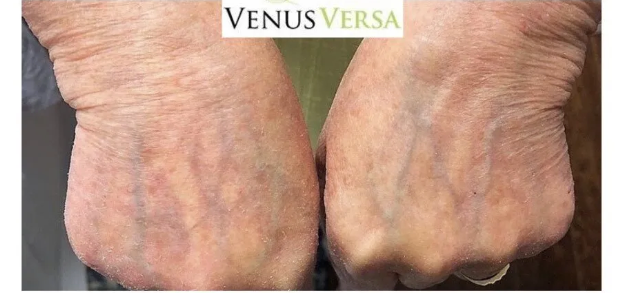 Two fists with visible veins. The hands are pale with wrinkles. 