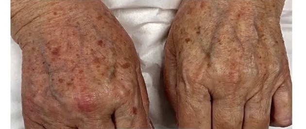 Hands with age spots and wrinkles.