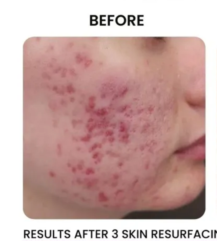 Face with acne before treatment; red inflamed spots.