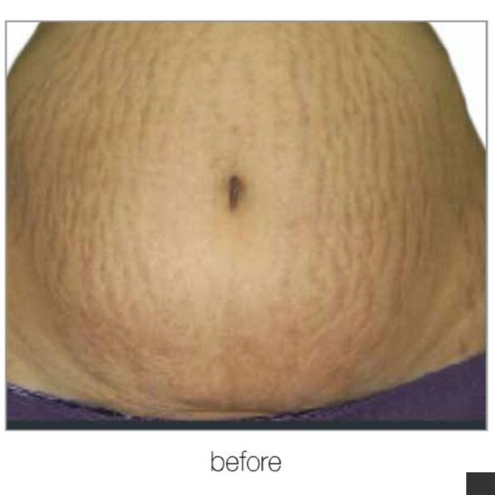 Abdomen with visible stretch marks, labeled 