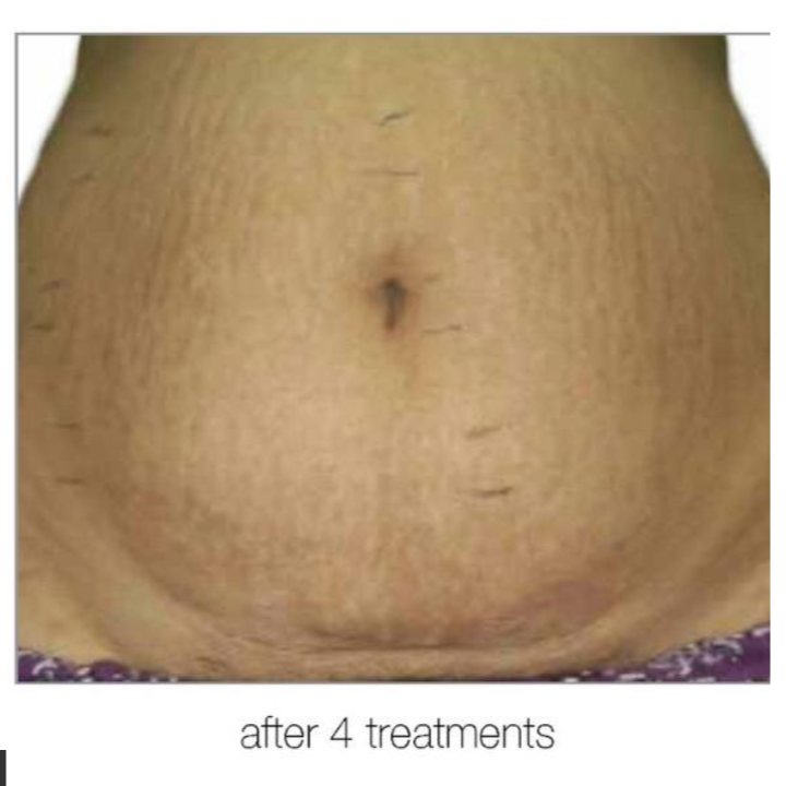 Abdomen with stretch marks after four treatments; skin is tan with small, dark hairs.