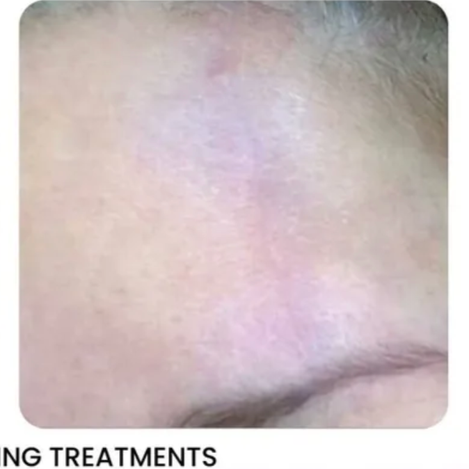 Close-up of skin, with visible texture and slight discoloration, possibly on a face.