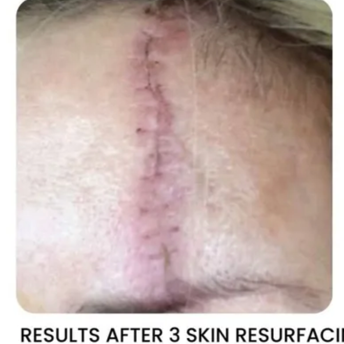 Forehead with surgical scar after skin resurfacing treatment.