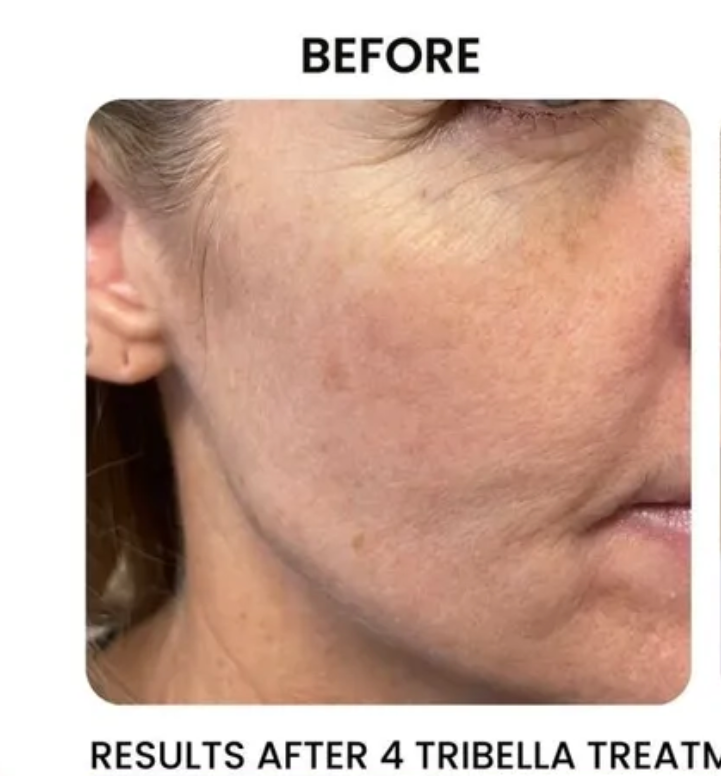 Close-up of a face, before treatment. Skin shows fine lines and discoloration. The text above reads: BEFORE.