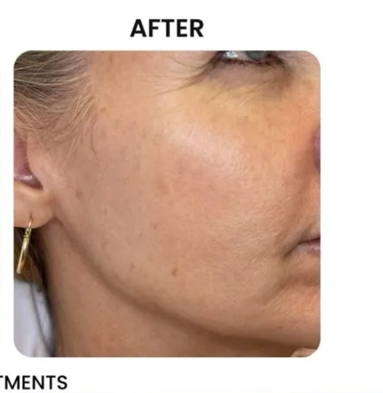 Close-up of a person's face after a treatment, showing smoother skin and reduced imperfections.