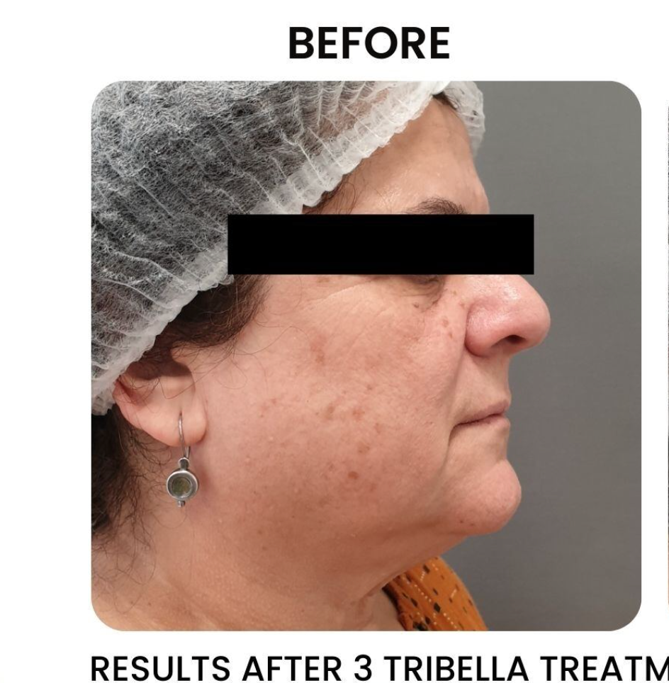 Profile view of a person before a Tribella treatment, showing skin discoloration and a double chin, wearing a hairnet.