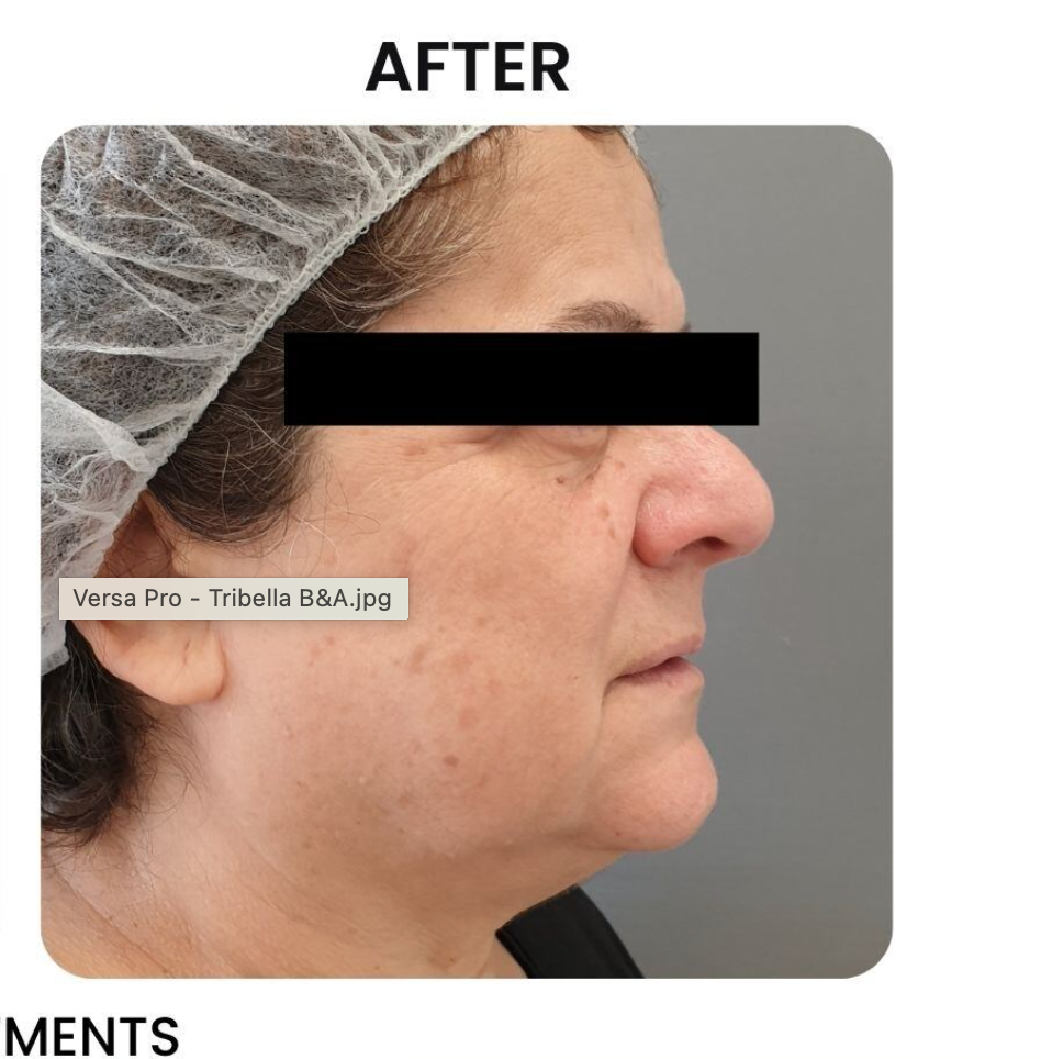 Side view of person's face after a treatment. Skin appears lighter with reduced spots. Wearing a surgical cap.