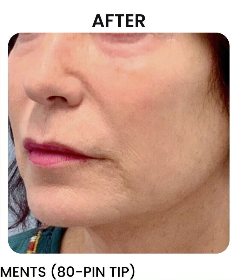 Close-up of a woman's face, after a procedure. The skin appears smoother with reduced wrinkles. Pink lipstick.