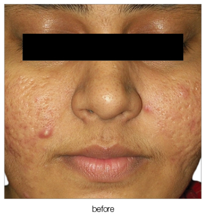 Close-up of a face with acne scars and one visible pimple on the left cheek; the word 
