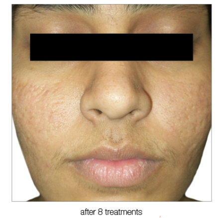 Face with skin texture improvements after eight treatments.