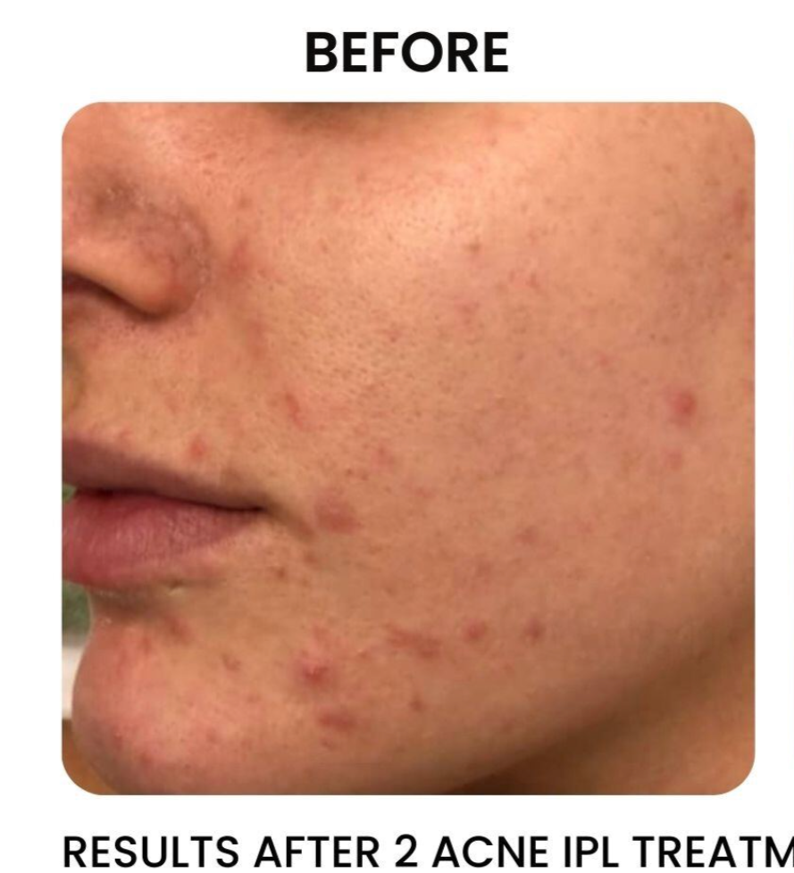 Close-up of a person's face showing acne before treatment. Red pimples and bumps visible on the skin.