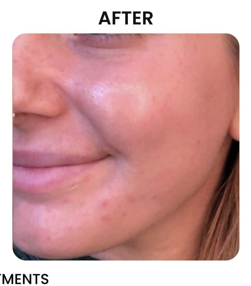 Side view of a person's face showing improved skin texture after treatments, with smooth skin and reduced blemishes.