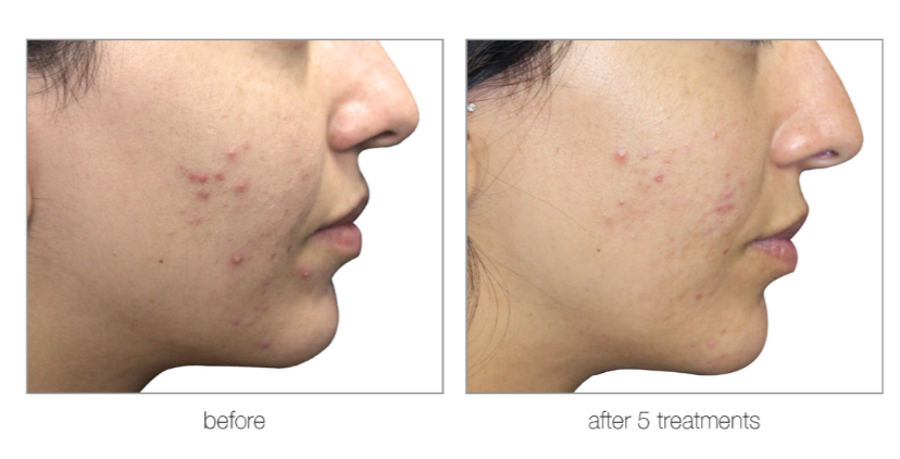 A before and after photo of a woman 's face with acne.