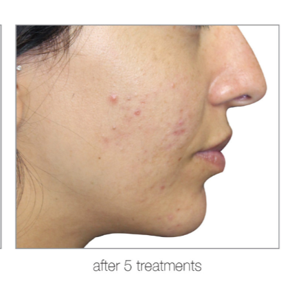 Profile of a person's face showing reduction in acne after 5 treatments, with pinkish blemishes on the cheek and chin.