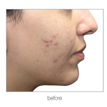 Profile view of a face with acne before treatment, showing red blemishes on cheek and jawline.