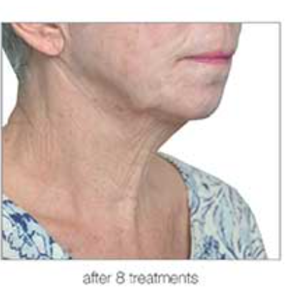 Neck of a person after 8 treatments; skin appears tighter, smoother, and less wrinkled.