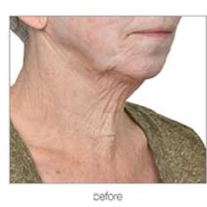 Close-up of a person's neck, showing wrinkled skin and signs of aging.