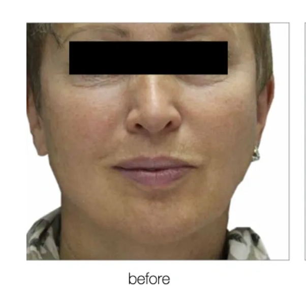 Face of a woman before a cosmetic procedure, showing wrinkles and skin imperfections.
