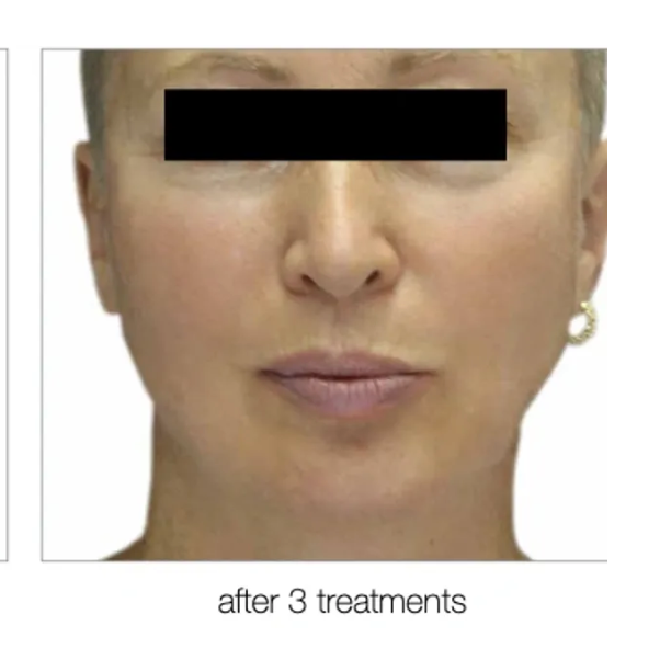Face after 3 treatments, with blacked-out eyes. Pink lips, fair skin, light-colored earring.