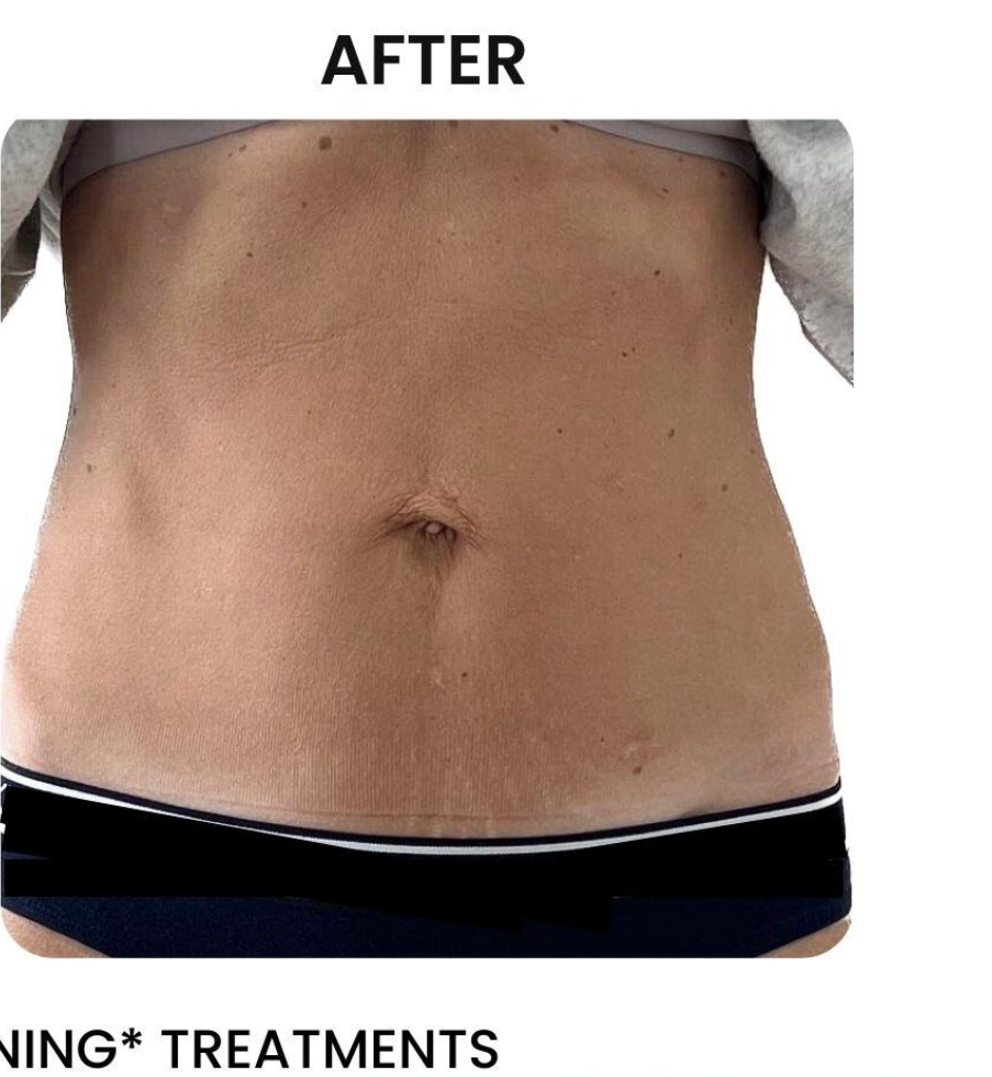 Post-treatment abdomen with reduced skin laxity.