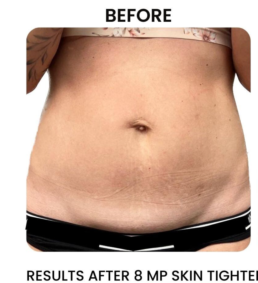 Abdomen before treatment, showing skin with stretch marks. The image is labeled 