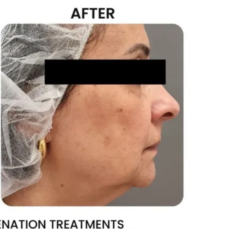 Side view of a person's face after rejuvenation treatments. Skin discoloration is visible. Person is wearing a hair net.