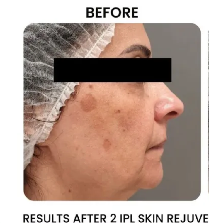 Woman's profile with skin discoloration; 