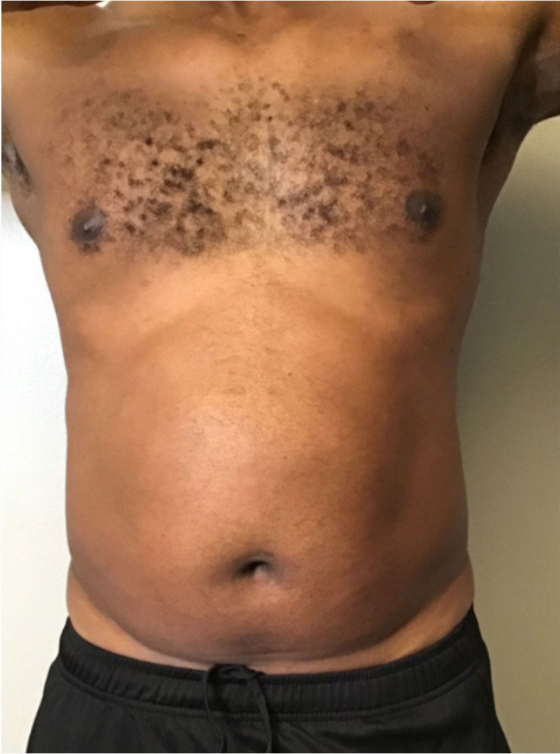 Torso of a person with dark skin, visible chest hair, and a slightly rounded abdomen, wearing black shorts.
