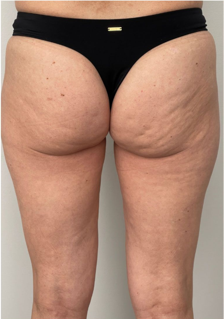 Buttocks and legs, rear view. Skin exhibits dimpling (cellulite). Wearing black underwear.