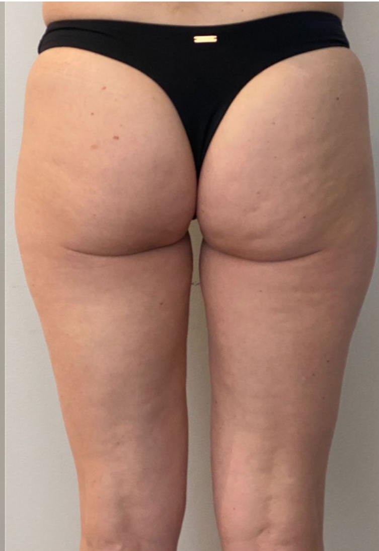 Rear view of a person wearing black thong underwear, showing thighs and buttocks with visible cellulite.