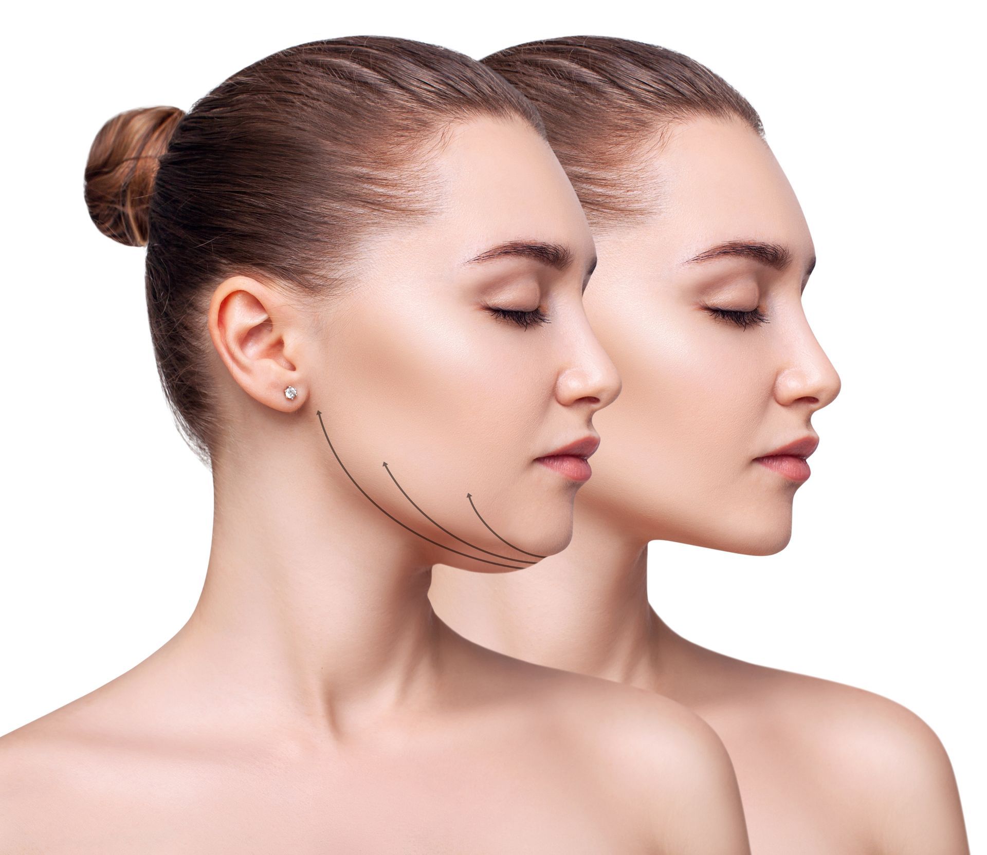 Two side-profile views of a woman's face, one with lines indicating a facelift.