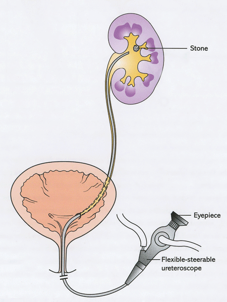 Kidney stone, urinary stone, ureteric stone, renal calculi, renal colic, nephrolithiasis