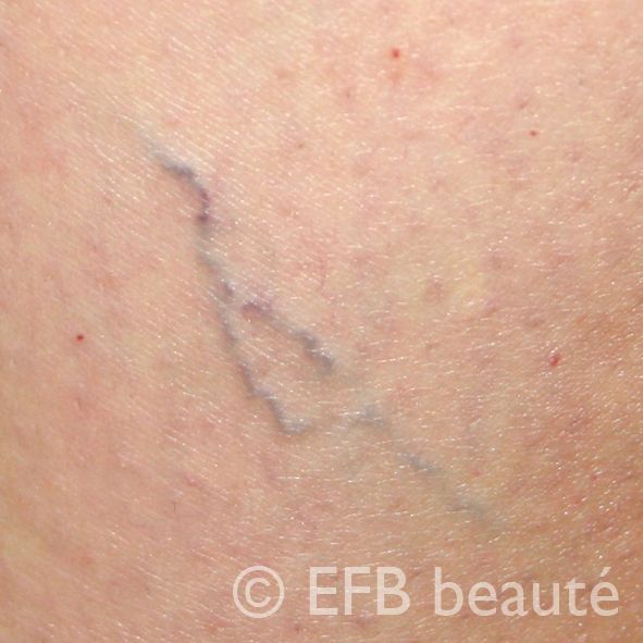 A close up of a person 's leg with varicose veins