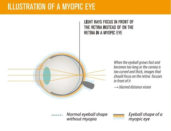Diagram of a myopic eye, showing light rays focusing in front of the retina, resulting in blurred distance vision.