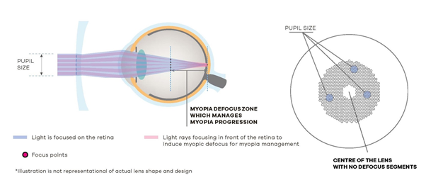 Diagram of an eye with light refraction and a lens; the diagram explains myopia management.