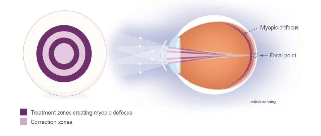Diagram of an eye. The cornea (left) shows concentric purple circles; a beam of light refracts through the eye.