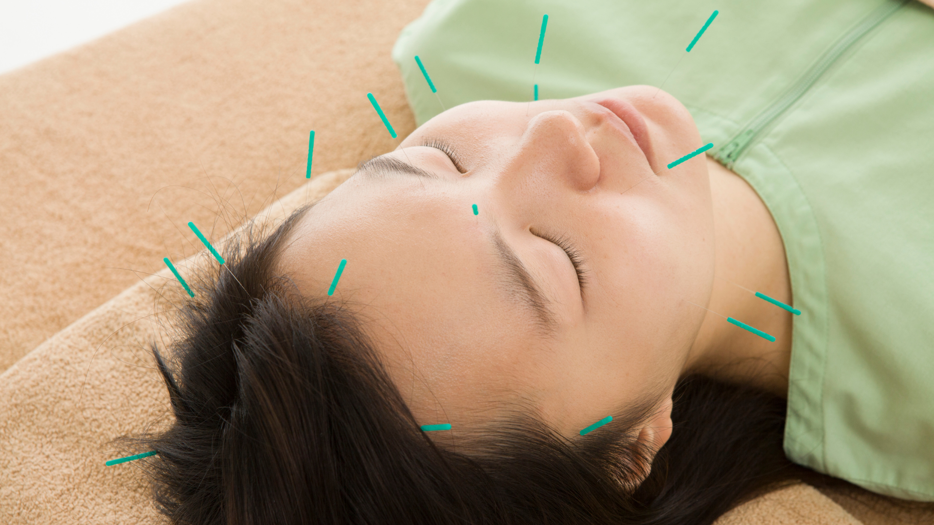Acupuncture and Migraines
