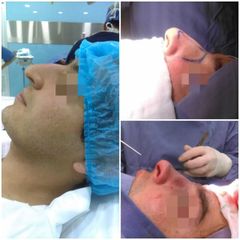 Rinoplastia funcional / estética