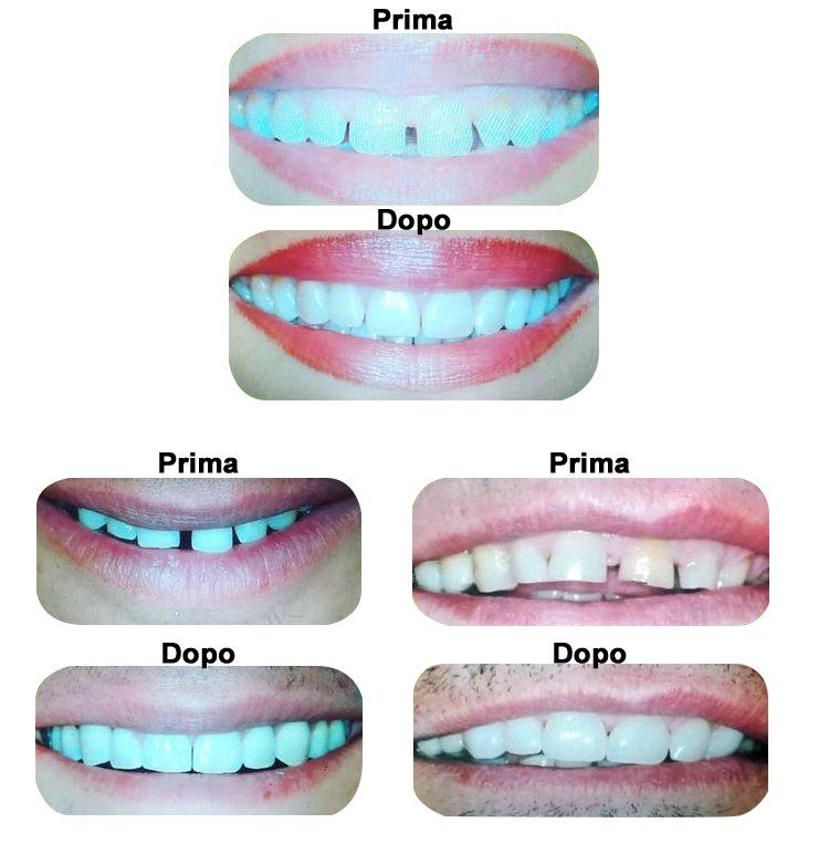 faccette dentali